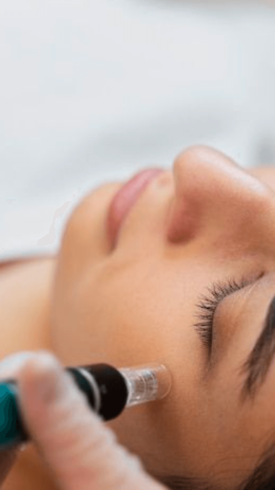 MICRONEEDLING - Gold Glow Beauty